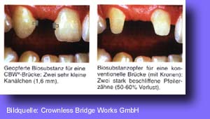 Implantate, Zahnarzt, Zahn, Kronen, Brücken, CBW, KCP, 3M, EDS, Zahnerhaltung, Zahnersatz, Parodontologie, Falkenberg, Füllungstherapie, Zahnsteinentfernung